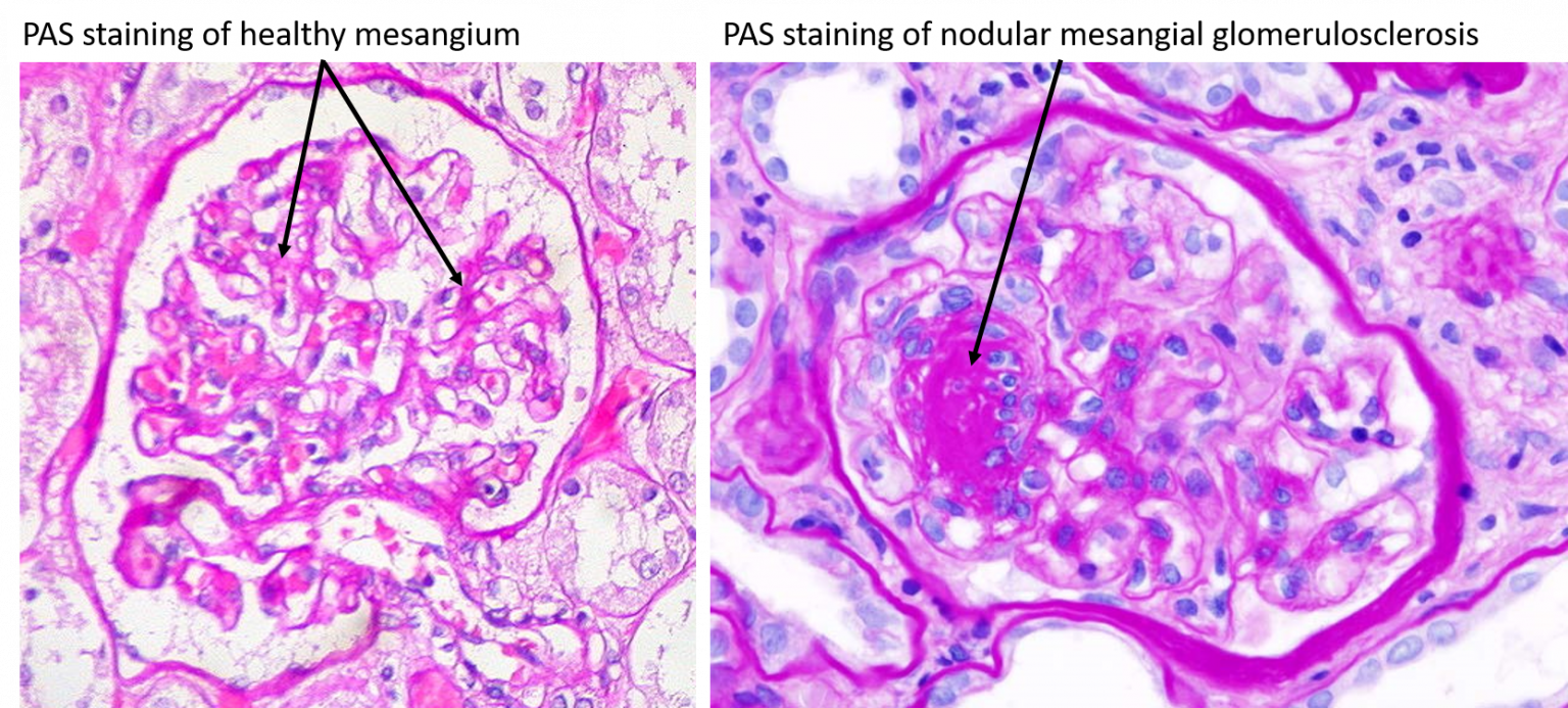 Renal Histology – UWSOM WWAMI Histopathology Thread