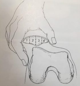 medial and lateral motion of the patella