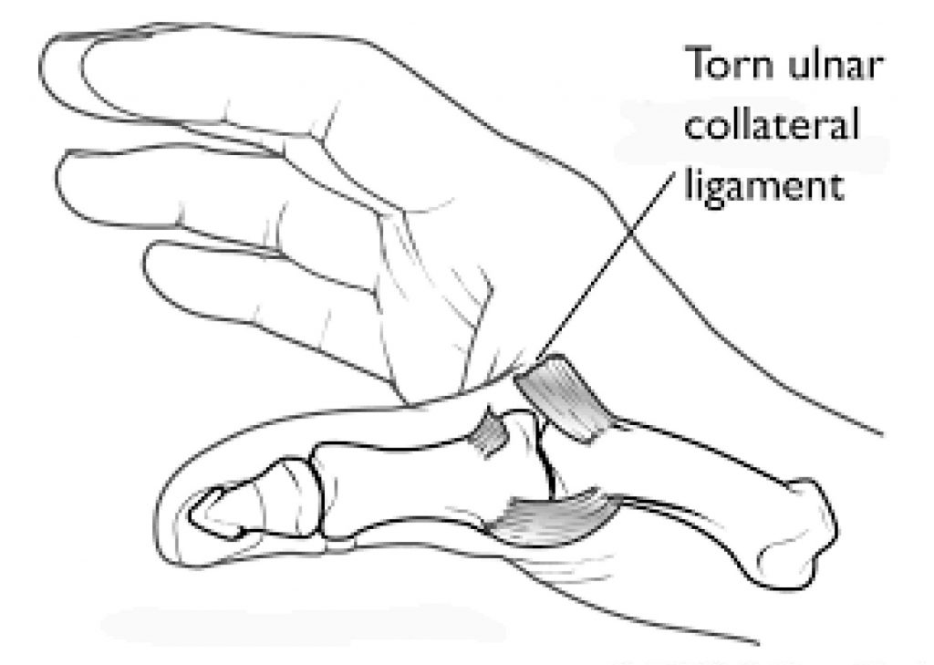 Illustration of torn ulnar collateral ligament