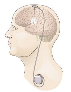 Illustration of a human head showing the brain and a deep brain stimulator, including the implant into the brain and the unit in the neck.