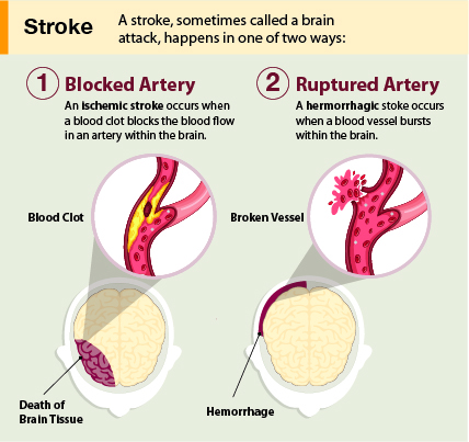 Types of stroke