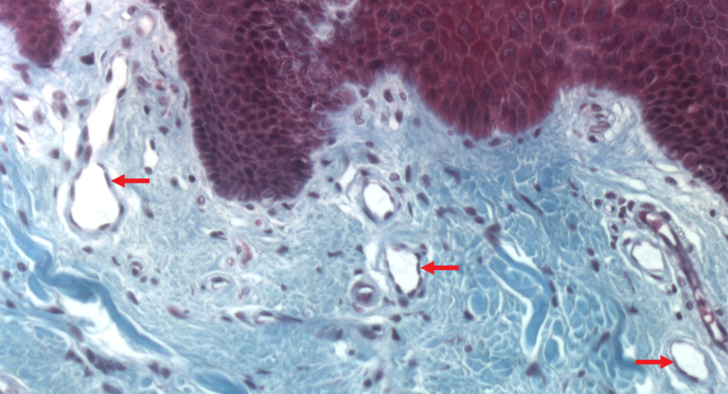 high magnification view of dermis showing capillaries (red arrows)