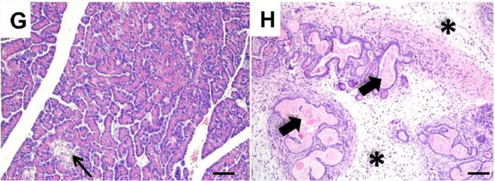 histology of normal pancreas (left) and pancreas from a ferret model of cystic fibrosis