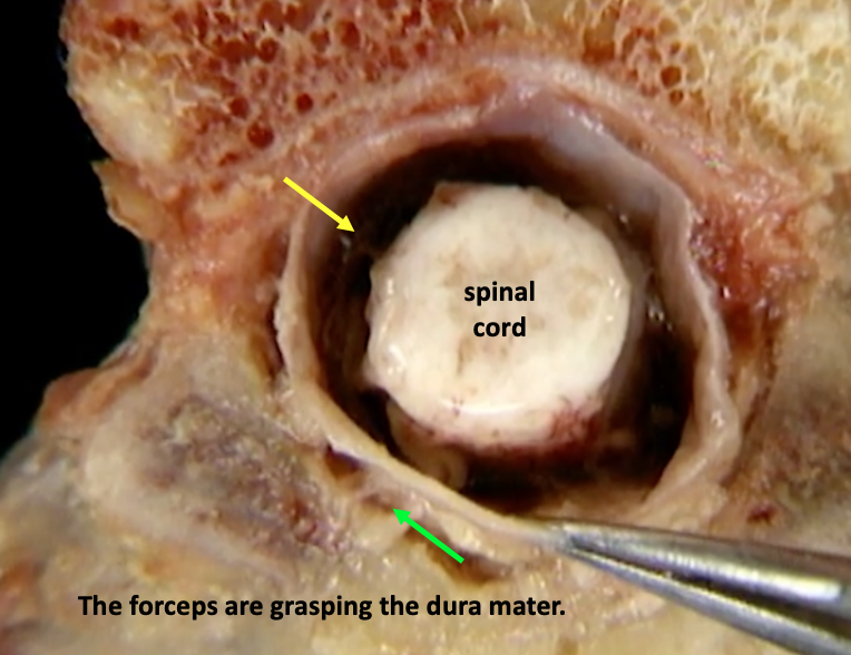 dissection showing spinal cord, dura mater, subarachnoid space, and epidural space