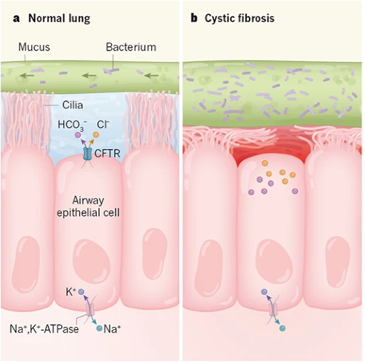 comparison of normal airway epithelium (left) and CF airway epithelium (right)