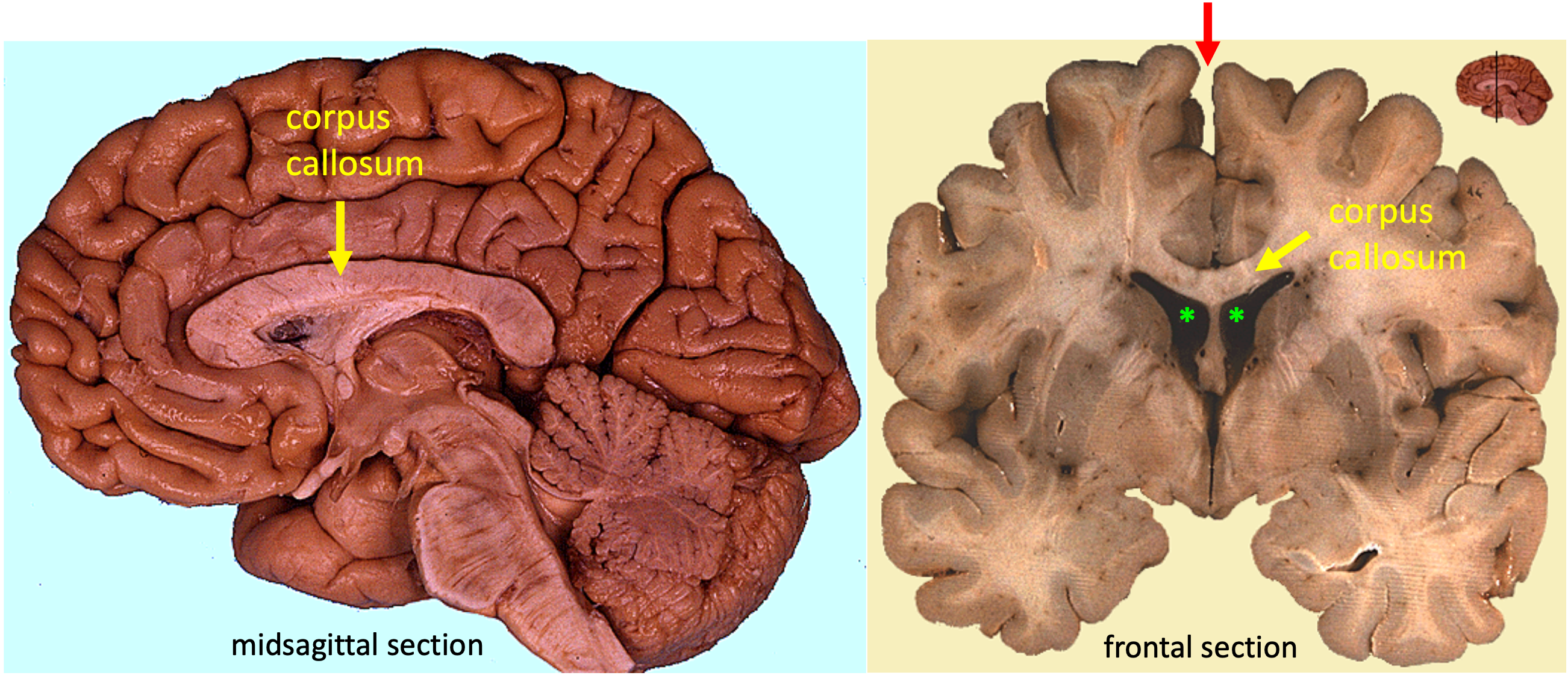 midsagittal (left) and frontal (right) sections of the human brain showing the corpus callosum