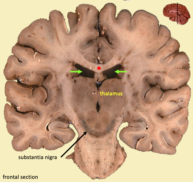 frontal section of the brain that shows the thalamus and the substantia nigra