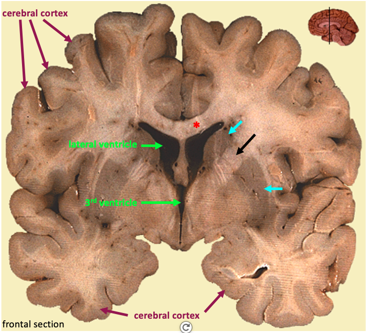 frontal section of the brain showing gray matter and white matter