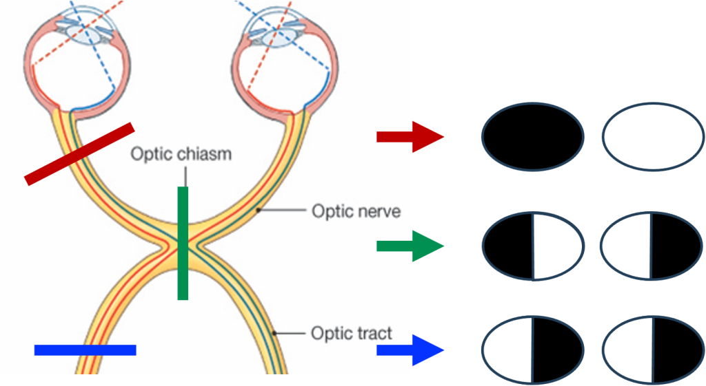 visual deficits associated with lesions in the visual pathways