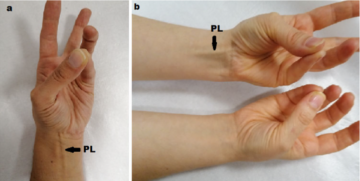 left: Schaeffer test where thumb is touching the fourth finger while flexing wrist to show palmaris longus tendon; right: a subject doing the Schaeffer test to reveal presence of the tendon on the left and absence of the tendon on the right.