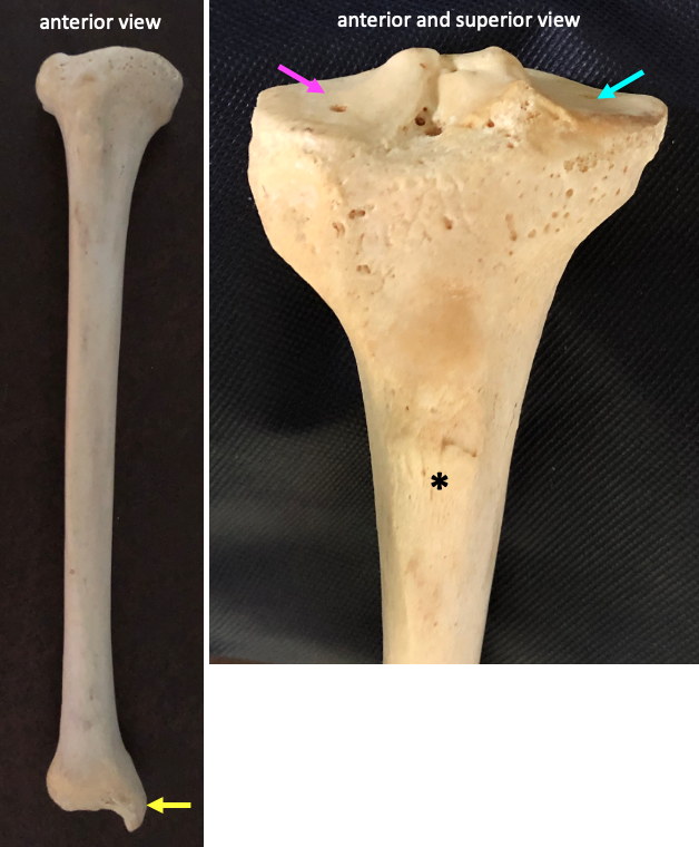 anterior view of full tibia (left) and enlarged anterior-superior view showing medial and lateral condyles (right)