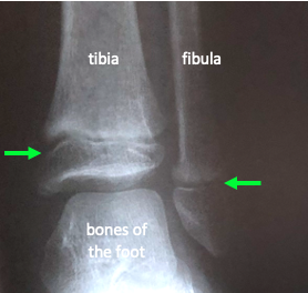 X-ray of a child's ankle showing dark regions (green arrows) where the epiphyseal growth plates are located.