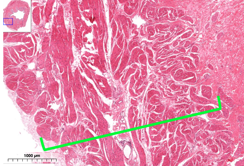 outer wall of bladder wooing detrusor muscle indicated by green bracket
