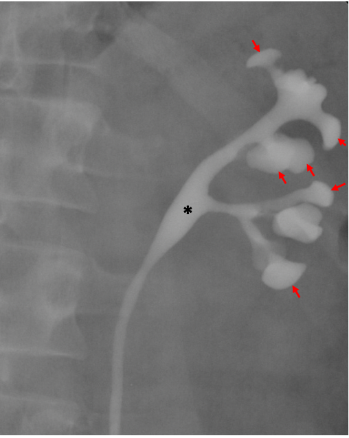 x-ray showing calyces, renal pelvis, and ureter