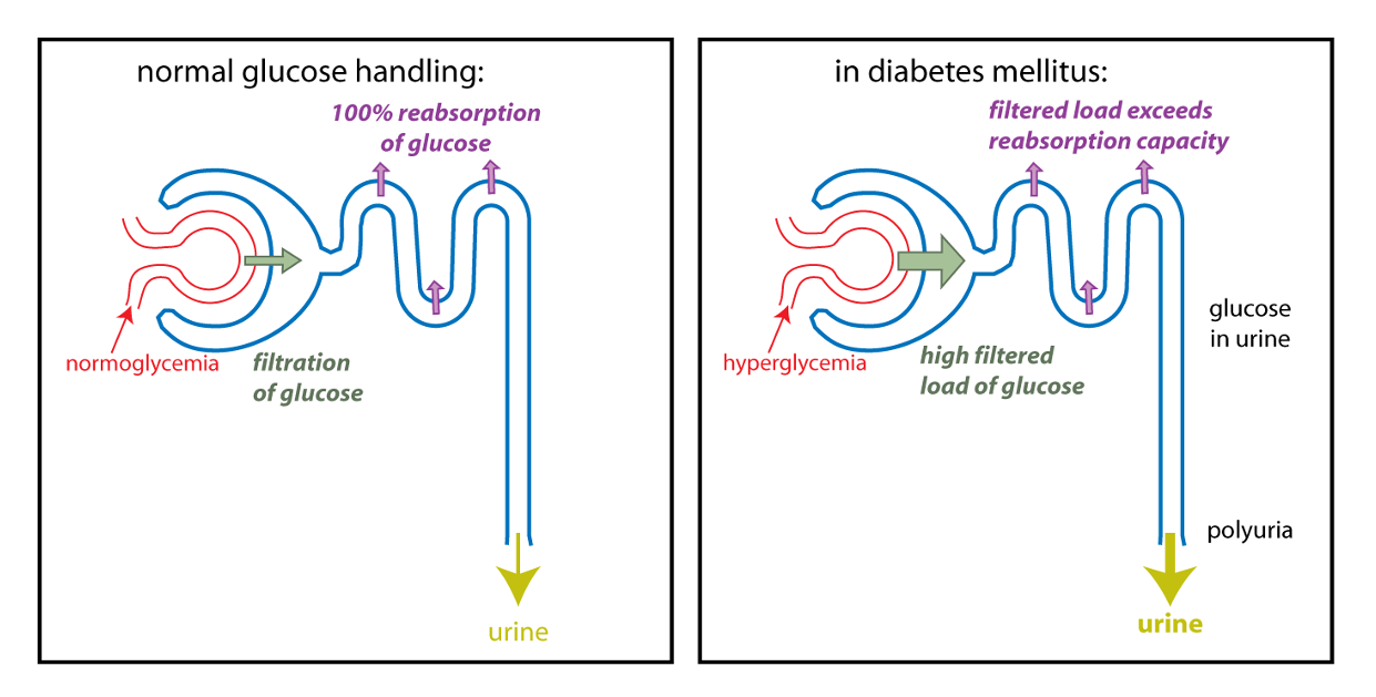 Schematic nephron diagrams showing the renal handling of glucose under normal circumstances (left) and in diabetes mellitus (right), with a larger arrow for urine indicating polyuria